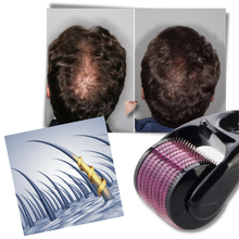 Load image into Gallery viewer, Rullo Derma per la crescita di capelli e barba - Ozerty
