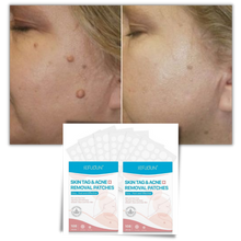 Load image into Gallery viewer, Cerotto per il trattamento di rimozione delle escrescenze della pelle - Ozerty
