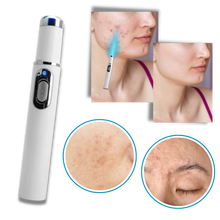 Carica l&#39;immagine nel visualizzatore di Gallery, Penna laser blu per la rimozione delle macchie scure - Ozerty
