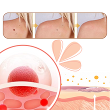 Load image into Gallery viewer, Rimuovi Escrescenze Cutanee Non-Invasivo - Ozerty
